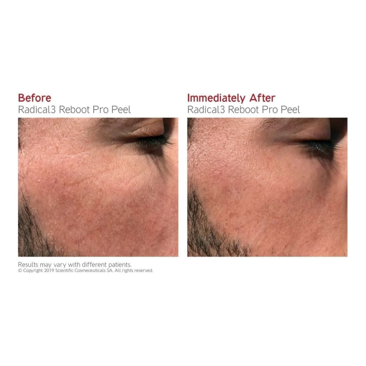 Dr. LEVY Switzerland Radical3 Reboot Pro Peel | The Clinic-Grade Resurfacer for a Total Skin Reboot!